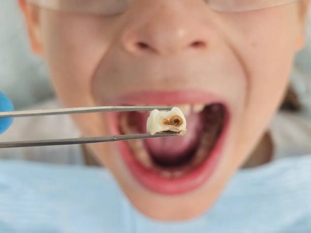 Best Emergency Wisdom Teeth Removal in Rahway, NJ